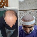 کلینیک کاشت مو آقای رضاپور در بابل