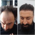 کلینیک کاشت مو آقای رضاپور در بابل