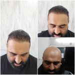 کلینیک کاشت مو آقای رضاپور در بابل