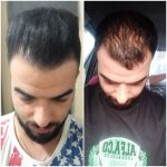 کلینیک کاشت مو آقای رضاپور در بابل