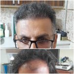کلینیک کاشت مو آقای رضاپور در بابل