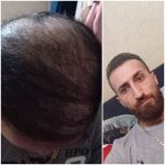 کلینیک کاشت مو آقای رضاپور در بابل
