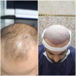 کلینیک کاشت مو آقای رضاپور در بابل