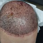 مرکز کاشت مو و ابرو رویال تبریز