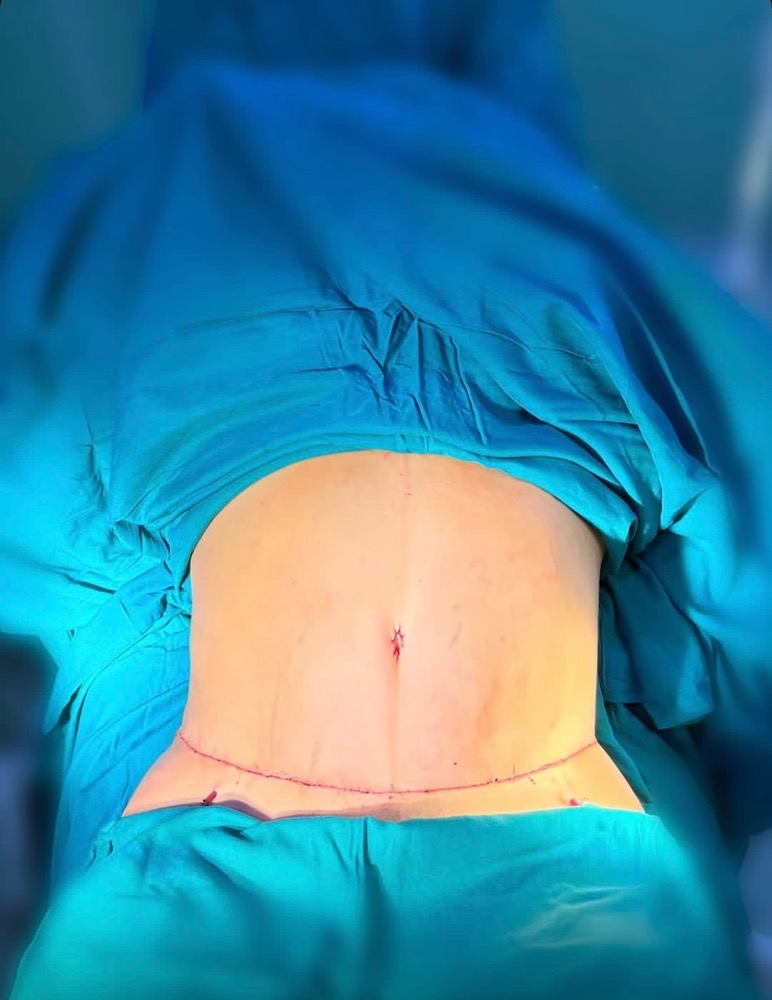 لیپوساکشن تخصصی مطب زیبایی دکتر امین صبوری فرد در مشهد-مشاغل ممتاز
