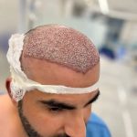 مرکز کاشت مو و ابرو امیر در خرم آباد
