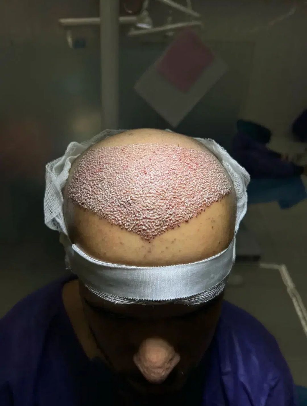 مرکز کاشت مو و ابرو امیر در خرم آباد کاشت مو به روش FIT - مشاغل ممتاز 