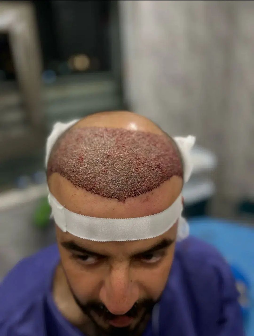 نتایج کاشت مو به روش FIT در مرکز امیر - مشاغل ممتاز