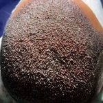 مرکز کاشت مو و ابرو زهرا ابراهیمی شیراز