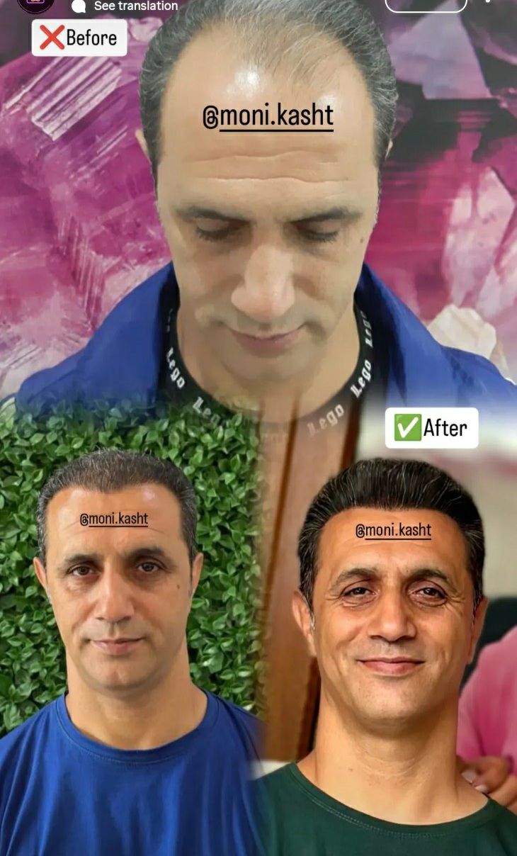 مرکز کاشت مو و ابرو مونا مهرپور الهیه تهران -مشاغل ممتاز