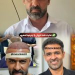 مرکز کاشت مو و ابرو مونا مهرپور الهیه تهران