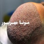 مرکز کاشت مو و ابرو مونا مهرپور الهیه تهران