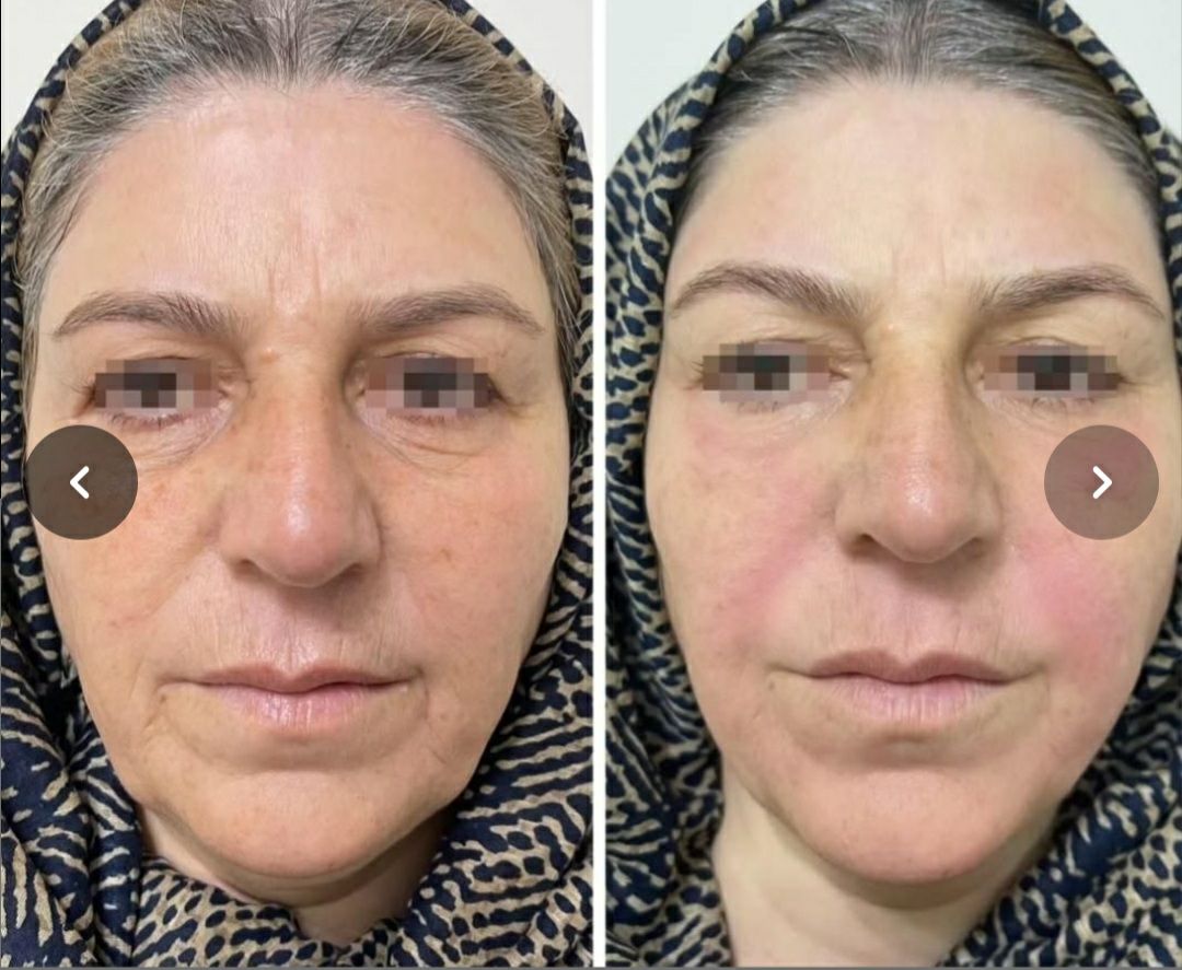جوانسازی پوست با خدمات هایفو حسینی معالی آباد شیراز -مشاغل ممتاز