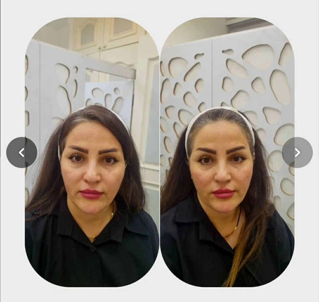 مرکز هایفوتراپی صورت در معالی آباد شیراز با لیفت غیرجراحی -مشاغل ممتاز