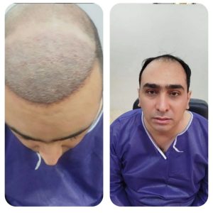 مرکز کاشت مو‌ کاکویی در کرمان-مشاغل ممتاز
