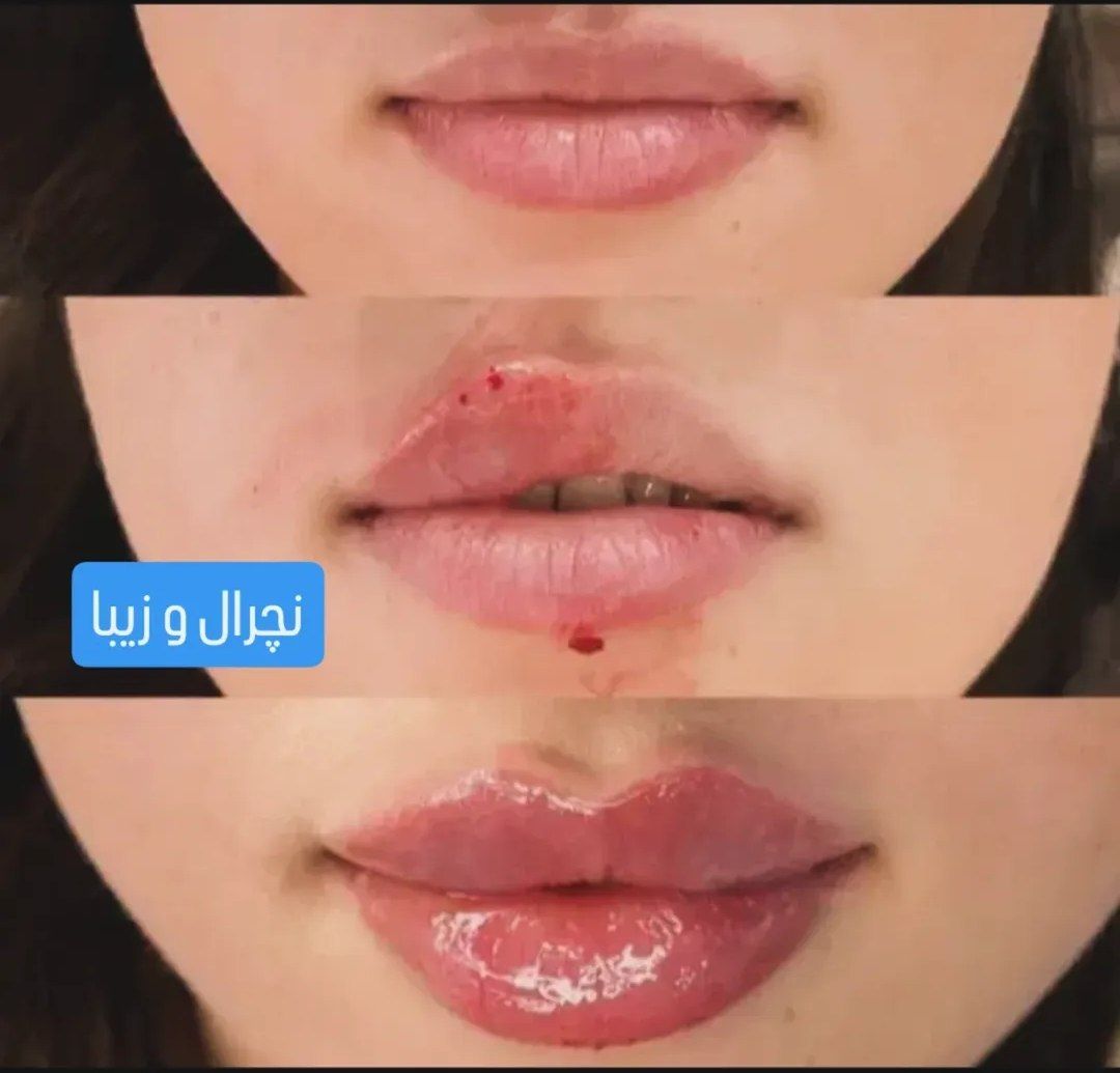 فیلر لب کلینیک زیبایی پایدار در تبریز-مشاغل ممتاز