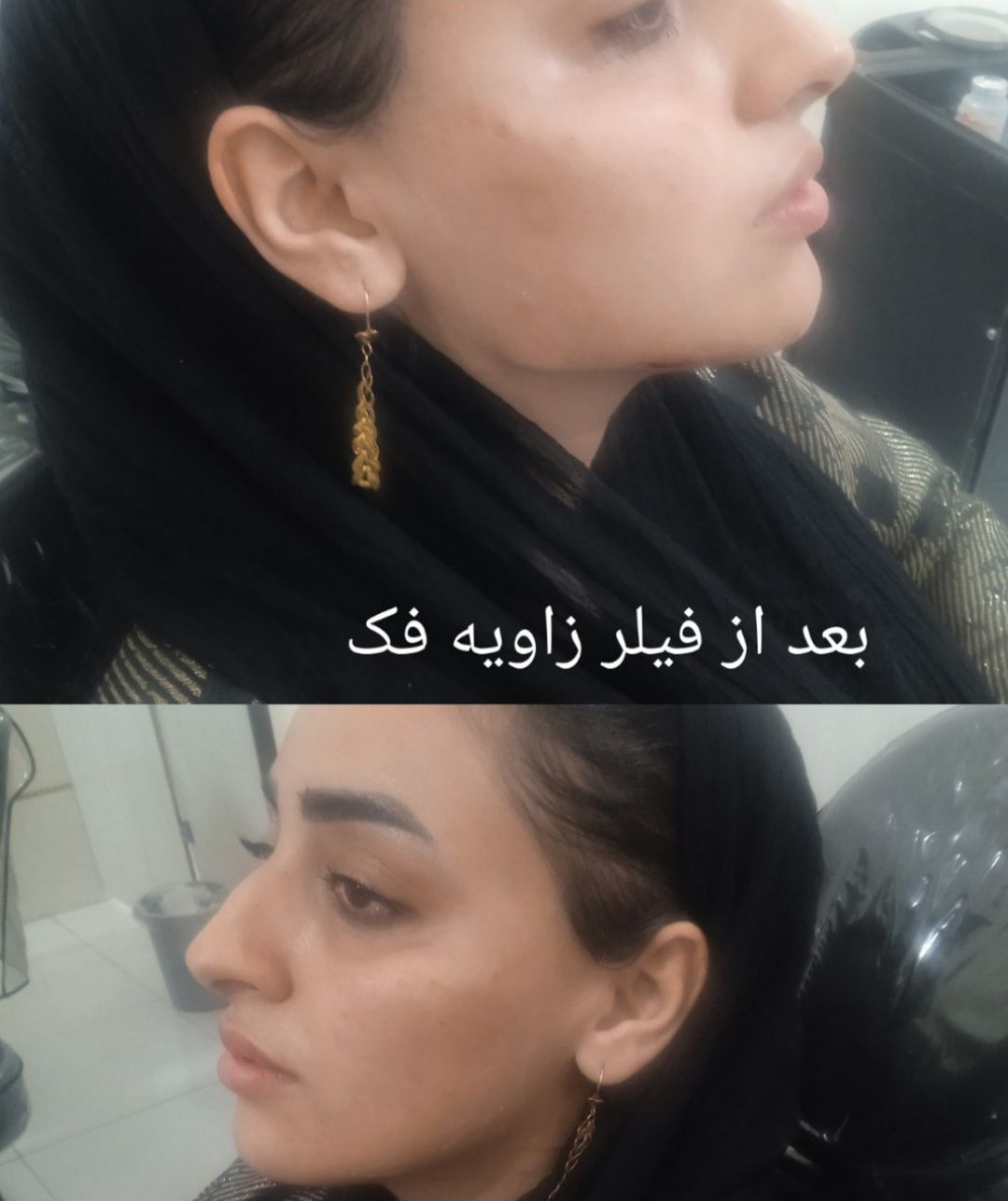 قبل و بعد فیلر زاویه فک مطب زیبایی سایماه در کرمان-مشاغل ممتاز