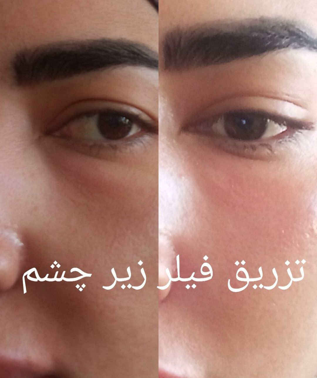 فیلر زیر چشم در کرمان-مشاغل ممتاز