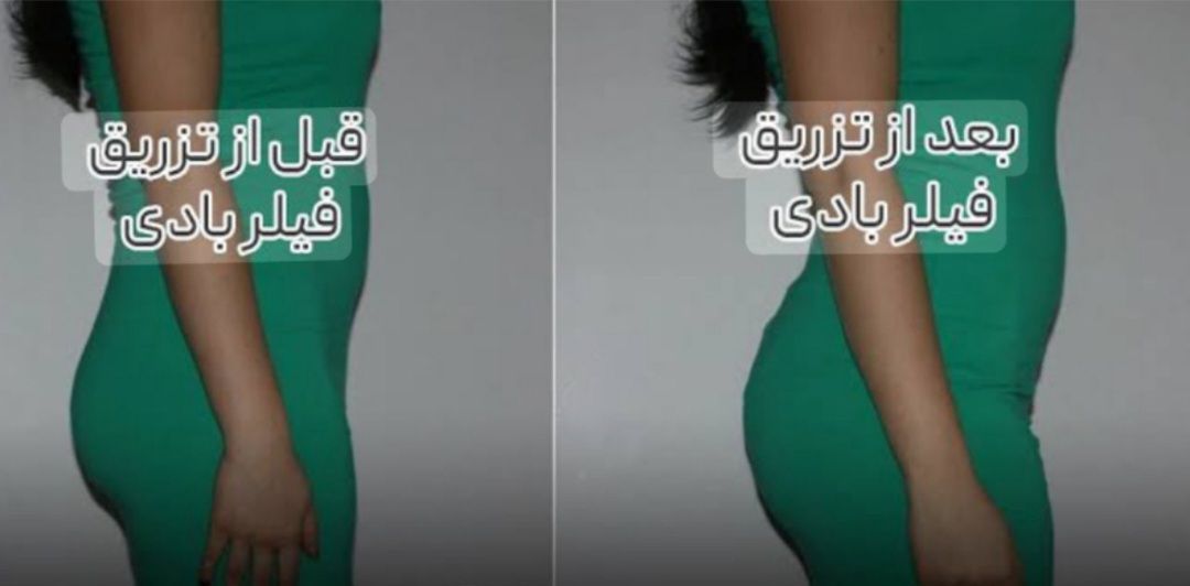 فیلر بادی مطب زیبایی سایماه در کرمان-مشاغل ممتاز