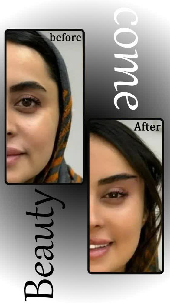 لیفت با نخ کلینیک زیبایی کام بیوتی اصفهان-مشاغل ممتاز