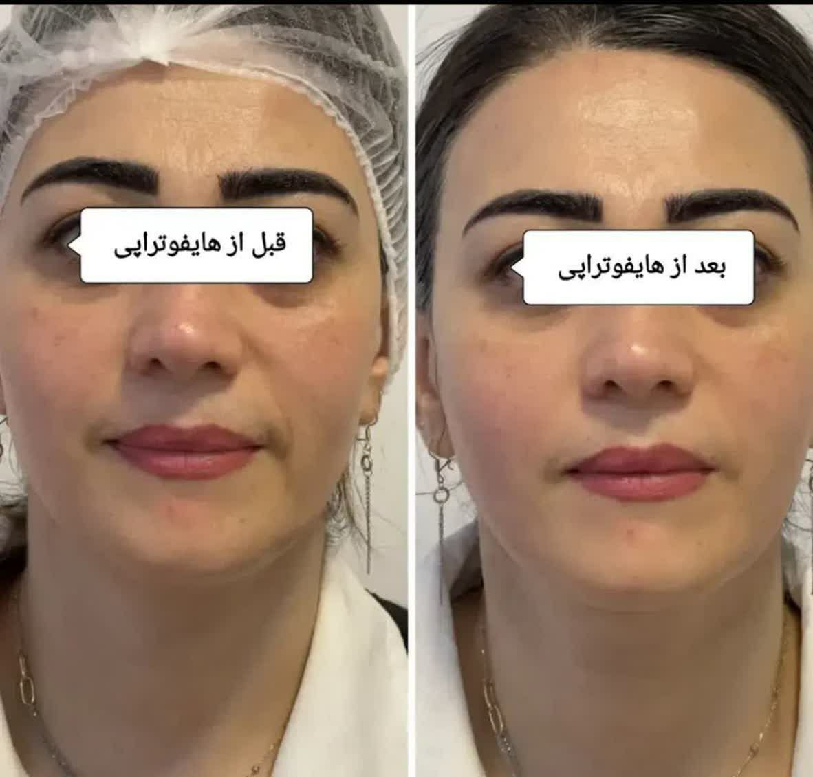 هایفوتراپی کلینیک زیبایی کام بیوتی اصفهان-مشاغل ممتاز