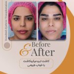 کاشت ابرو فرشته امینی در شیراز