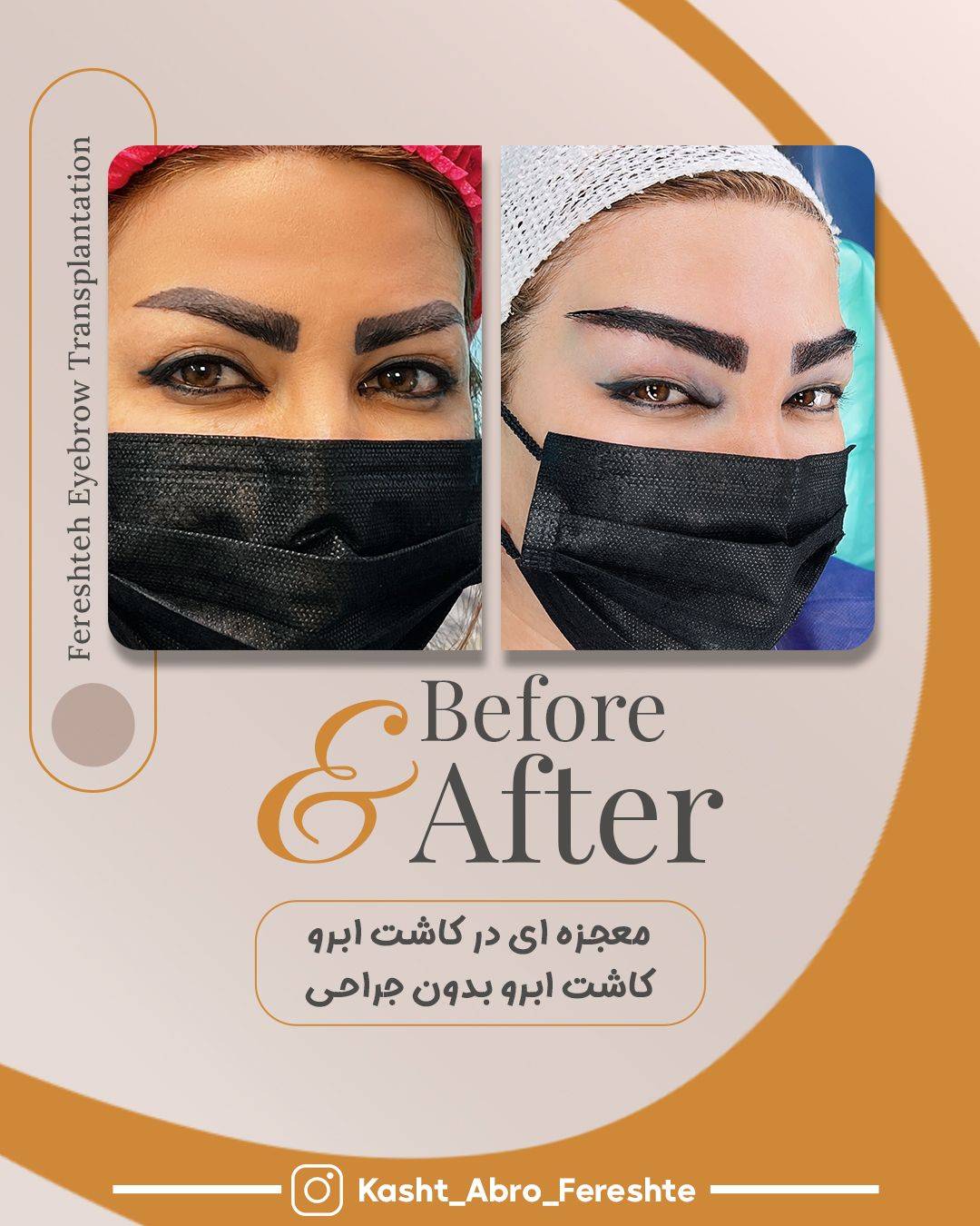 نمونه کار کاشت ابرو طبیعی در شیراز توسط فرشته امینی -مشاغل ممتاز