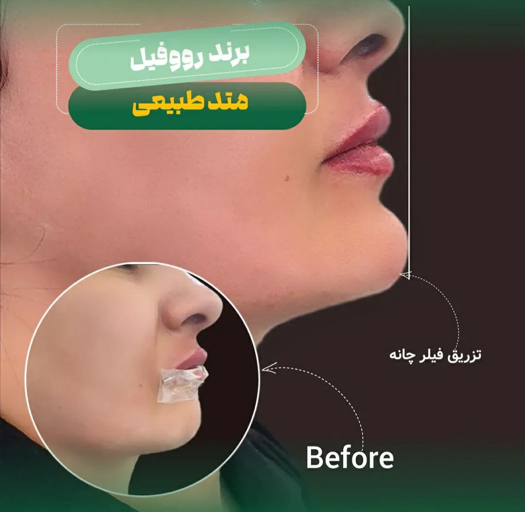 تزریق فیلر چانه جهت اصلاح فرم و تقارن صورت در مجتمع پزشکی آوین فولادشهر - مشاغل ممتاز