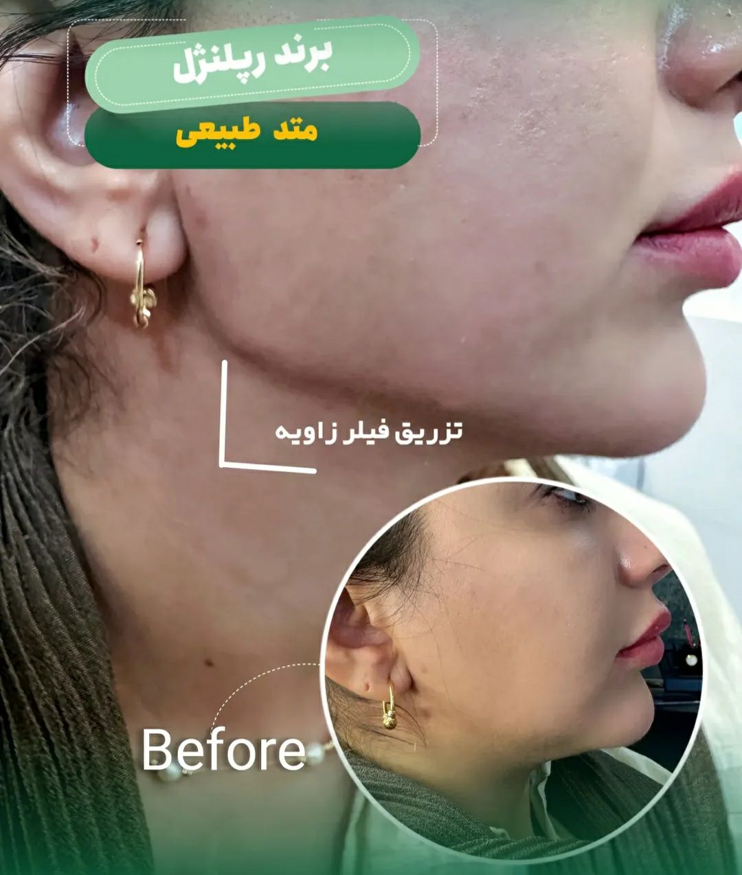 فیلر زاویه سازی صورت و مادلینگ چهره در مجتمع پزشکی آوین فولادشهر - مشاغل ممتاز