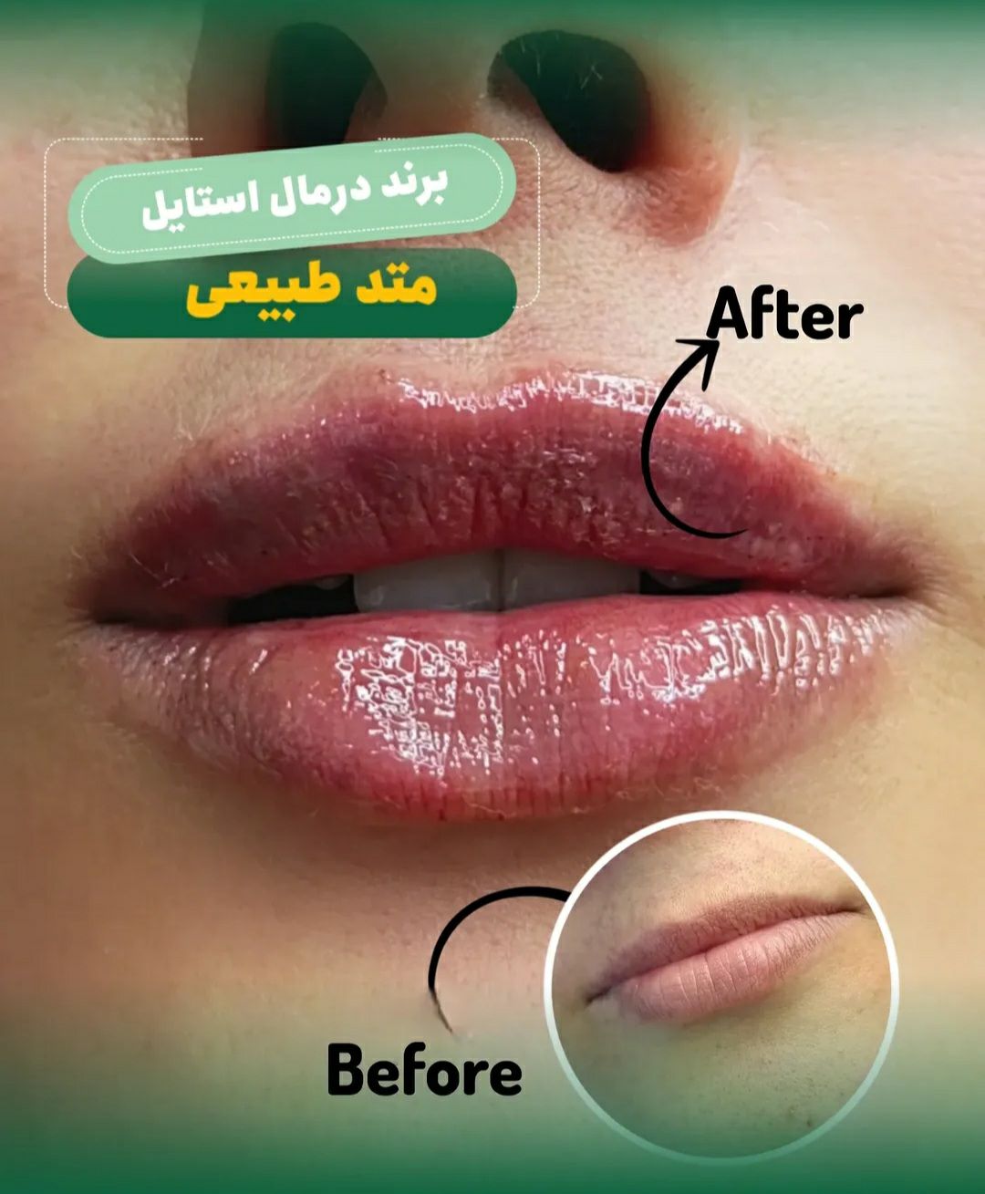 تزریق فیلر لب طبیعی و روسی در مجتمع پزشکی آوین فولادشهر - مشاغل ممتاز