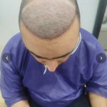 مرکز کاشت مو‌ کاکویی در کرمان