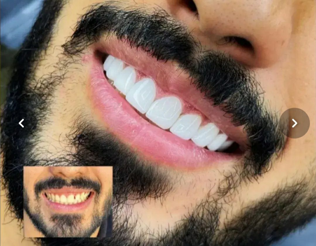 خدمات ترمیم دندان و عصب‌کشی در دندانپزشکی دکتر فرشاد عبدی خرم‌آباد -مشاغل ممتاز
