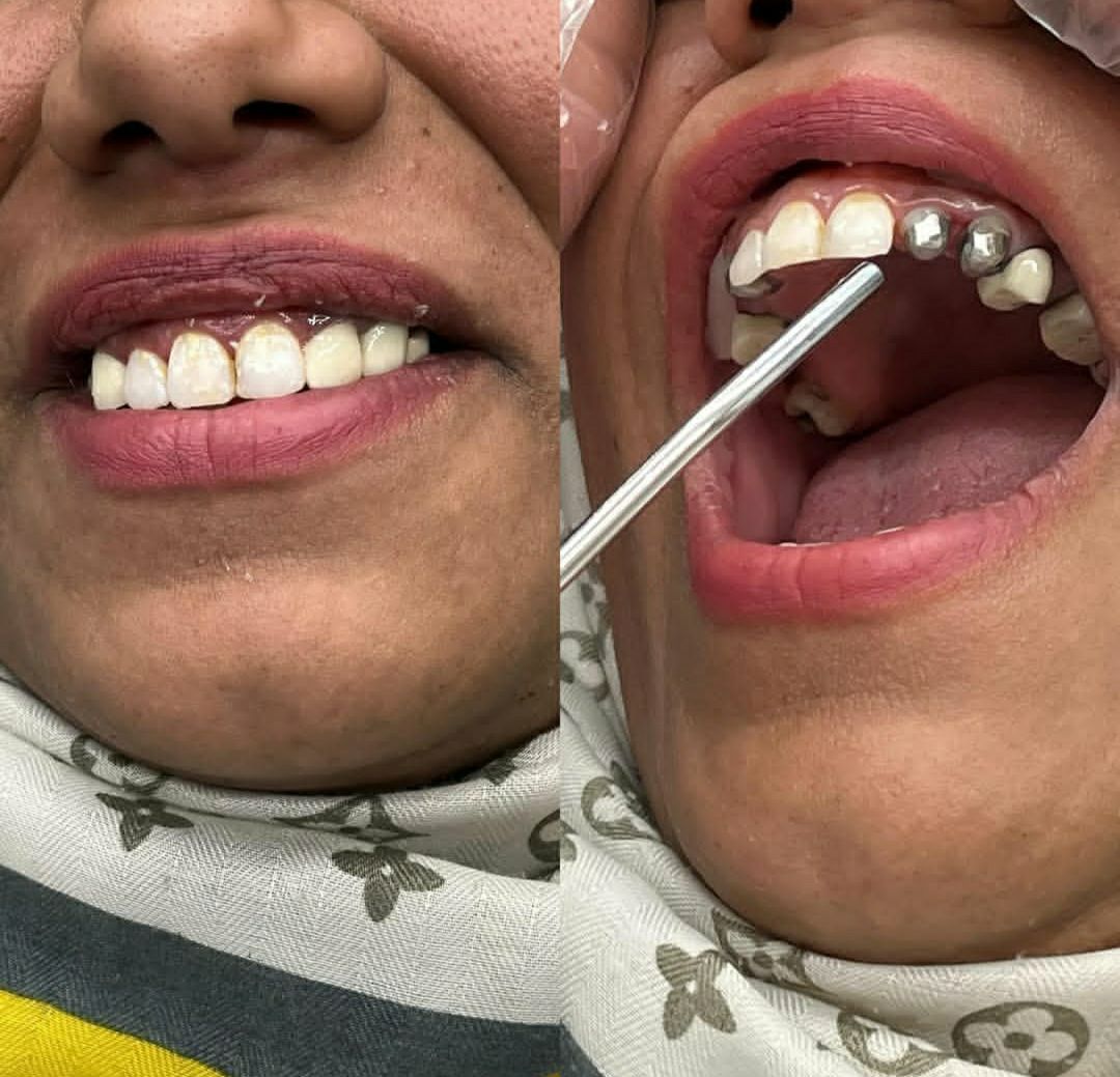 خدمات تخصصی ایمپلنت و اوردنچر در مطب دندانپزشکی دکتر حسین سالاری کرمان-مشاغل ممتاز
