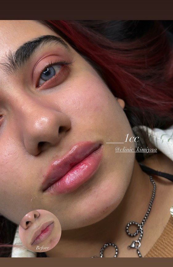 تزریق فیلر لب در کلینیک زیبایی کیمیا اهواز با متدهای جدید -مشاغل ممتاز