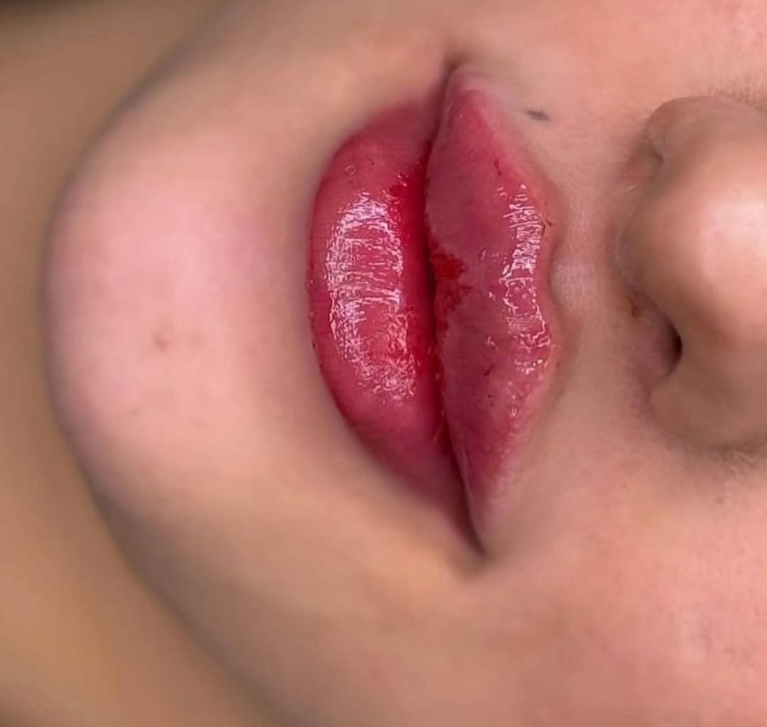 تزریق ژل لب طبیعی در مرکز زیبایی الماس تبریز-مشاغل ممتاز