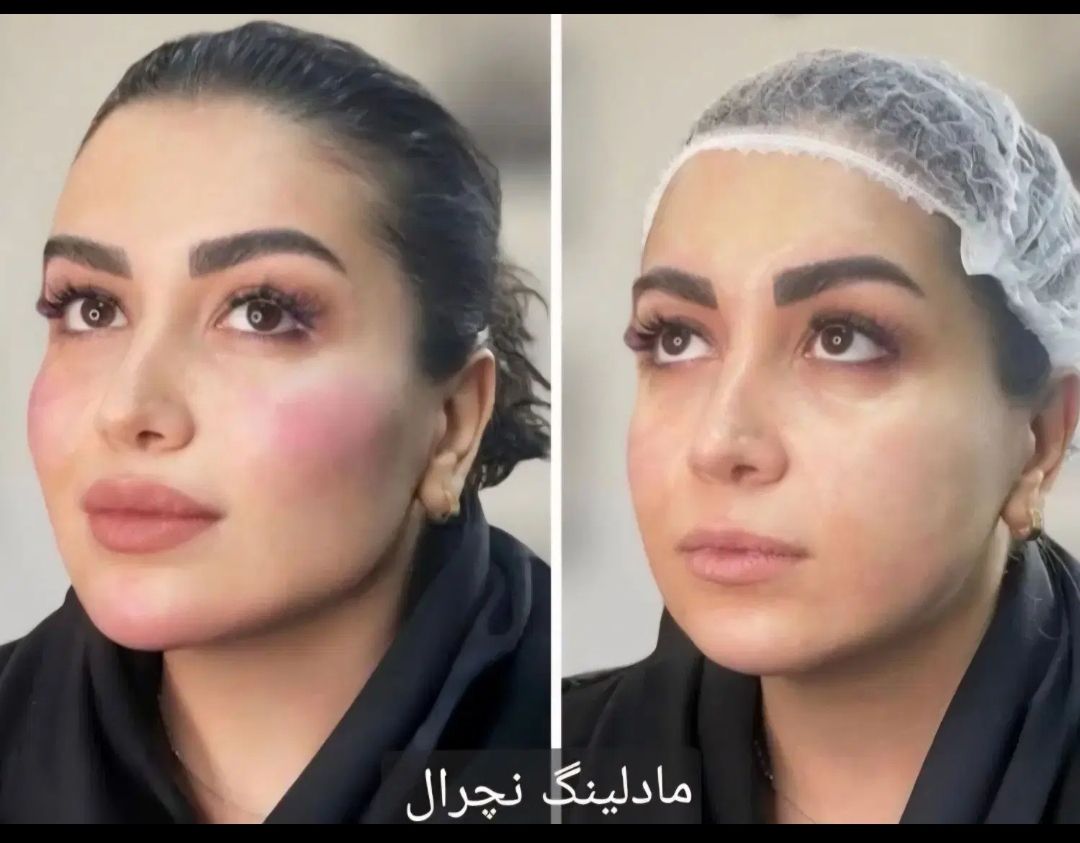 قبل و بعد مادلینگ نچرال کلینیک رز-مشاغل ممتاز