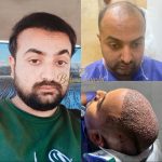 مرکز کاشت مو و ابرو بهروکاشت در شیراز