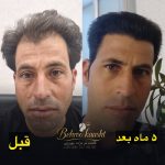 مرکز کاشت مو و ابرو بهروکاشت در شیراز