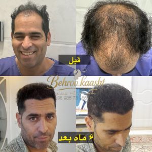 مرکز کاشت مو و ابرو بهروکاشت در شیراز-مشاغل ممتاز