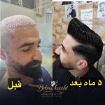 مرکز کاشت مو و ابرو بهروکاشت در شیراز