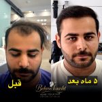 مرکز کاشت مو و ابرو بهروکاشت در شیراز