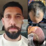 مرکز کاشت مو و ابرو بهروکاشت در شیراز