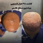 مرکز کاشت مو و ابرو بهروکاشت در شیراز