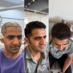 مرکز کاشت مو و ابرو بهروکاشت در شیراز