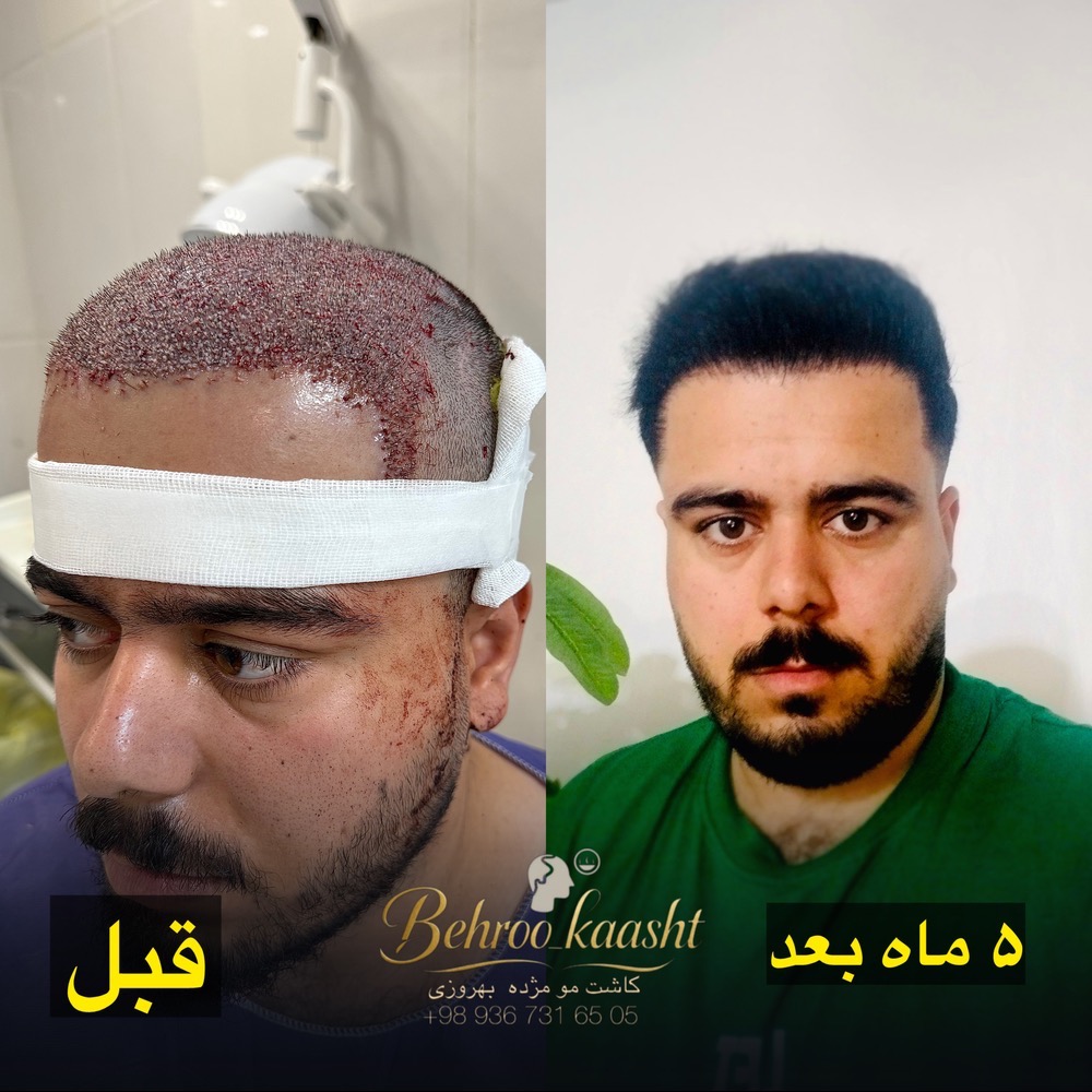 پیوند مو طبیعی در مرکز کاشت مو و ابرو بهروکاشت در شیراز – مشاغل ممتاز