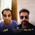 مرکز کاشت مو و ابرو بهروکاشت در شیراز