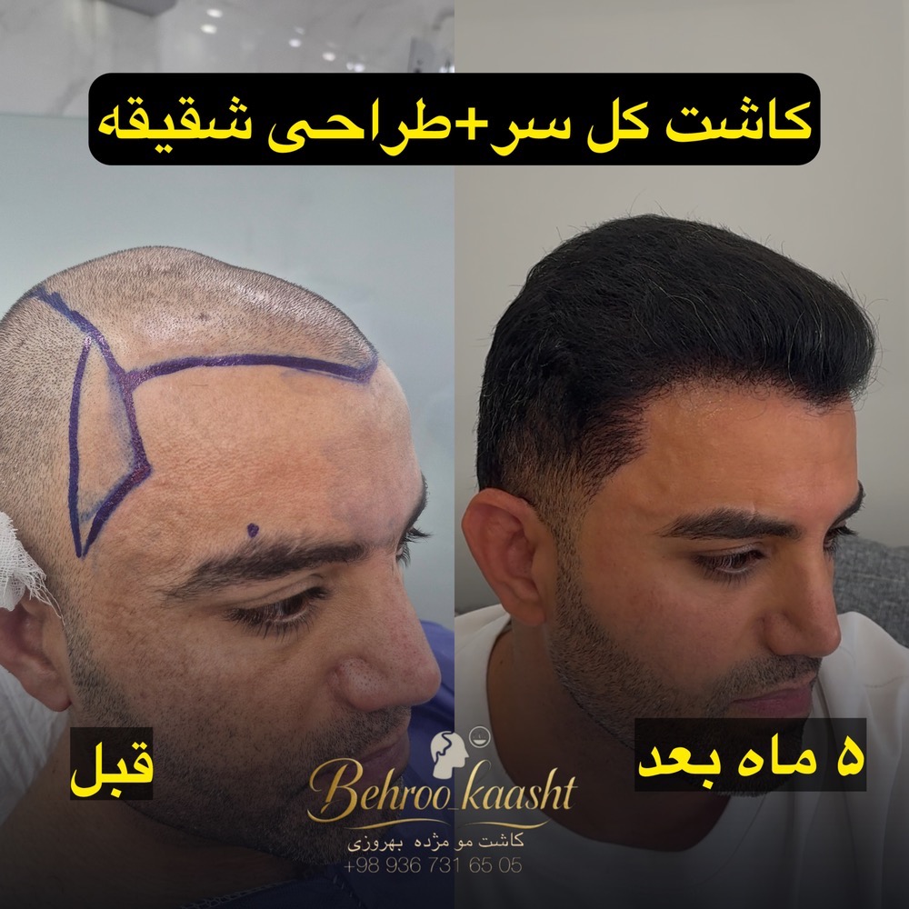 قبل و بعد کاشت مو مرکز کاشت مو و ابرو بهروکاشت در شیراز – مشاغل ممتاز
