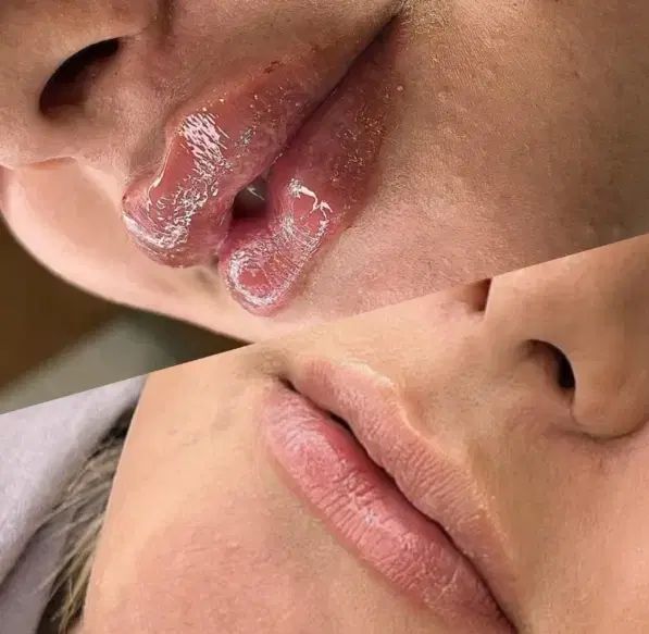 تزریق ژل لب و بوتاکس در کلینیک زیبایی آیلین در تهران_مشاغل ممتاز