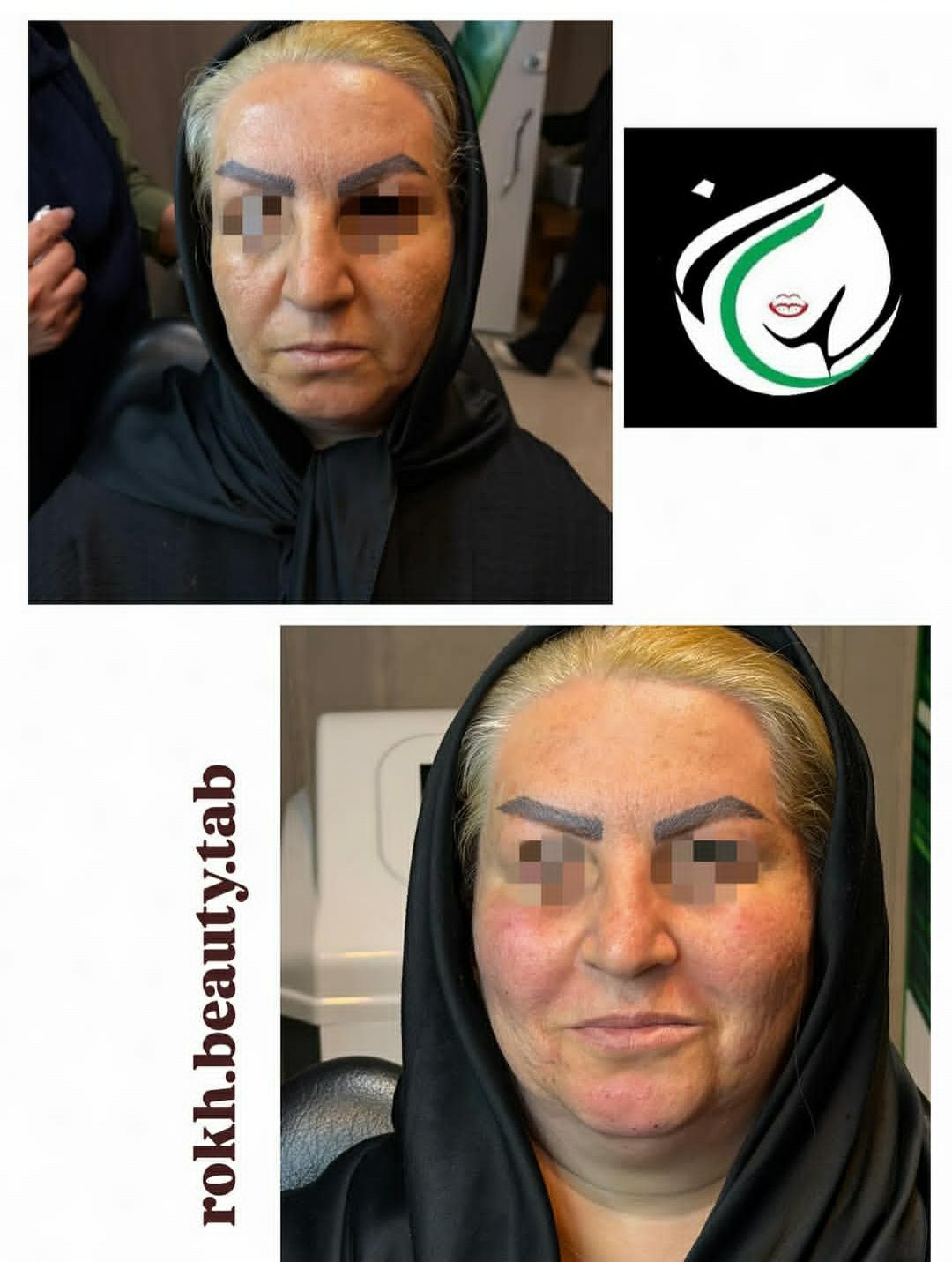 قبل و بعد جوانساز مطب زیبایی آناطب تبریز-مشاغل ممتاز
