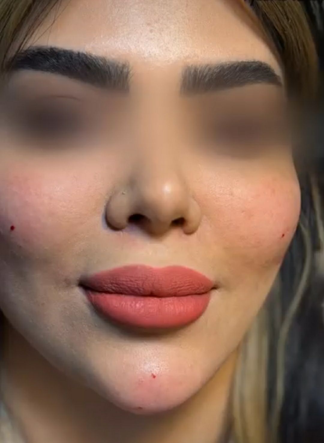 خدمات مزوتراپی صورت برای افزایش شادابی در مطب زیبایی آناطب تبریز -مشاغل ممتاز